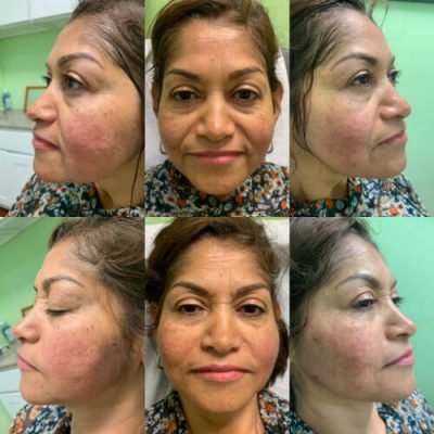 02-Before-After-Pics-Liposuction_Tummy-Tuck_Breast-Augmentation_Implant_-Botox_Lip-Fillers_El-Monte-CA-91731-ohl7x66sb9u821ruz8hqltjsr67domnbzf6t4y0g4g
