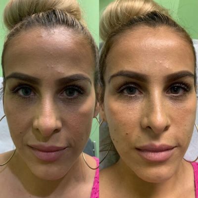 04-Before-After-Pics-Liposuction_Tummy-Tuck_Breast-Augmentation_Implant_-Botox_Lip-Fillers_El-Monte-CA-91731-ohl7x9y52lzdchmeda48vsln4poujf29bxsr21uvfk