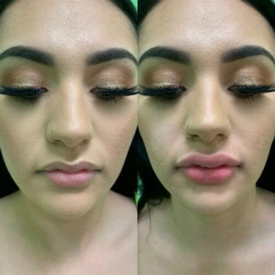06-Before-After-Pics-Liposuction_Tummy-Tuck_Breast-Augmentation_Implant_-Botox_Lip-Fillers_El-Monte-CA-91731-ohl7xcrnn438bbiawtc4l9w0wvay6idgcbr7hvqoww