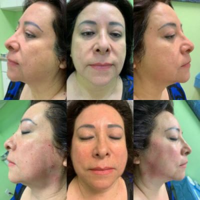 07-Before-After-Pics-Liposuction_Tummy-Tuck_Breast-Augmentation_Implant_-Botox_Lip-Fillers_El-Monte-CA-91731-ohl7xenc0s5syjfklu5dq9ey3n1olwkx0l26gfnwkg