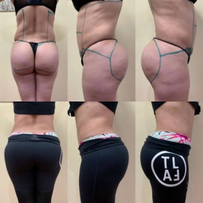 08-Before-After-Pics-Liposuction_Tummy-Tuck_Breast-Augmentation_Implant_-Botox_Lip-Fillers_El-Monte-CA-91731-ohl7z4oojuiq8sxgjkyratrdb2jwpxf794484p3x5s