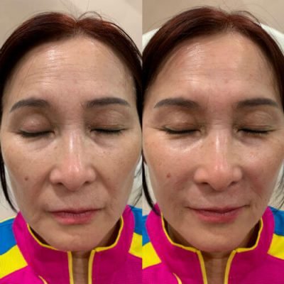 10-Before-After-Pics-Liposuction_Tummy-Tuck_Breast-Augmentation_Implant_-Botox_Lip-Fillers_El-Monte-CA-91731-ohl7z6kcxilaw0uq8ls0ftaahuan5bmnxdf73914tc