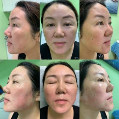 11-Before-After-Pics-Liposuction_Tummy-Tuck_Breast-Augmentation_Implant_-Botox_Lip-Fillers_El-Monte-CA-91731-ohl7z8g1b6nvj8rzxml9kst7om1dkpu4lmq61sycgw