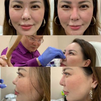 12-Before-After-Pics-Liposuction_Tummy-Tuck_Breast-Augmentation_Implant_-Botox_Lip-Fillers_El-Monte-CA-91731-ohl7zb9jvorqi2nwh5t5aa3lgrnh7t5bm0omhmu5y8