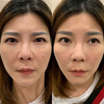 15-Before-After-Pics-Liposuction_Tummy-Tuck_Breast-Augmentation_Implant_-Botox_Lip-Fillers_El-Monte-CA-91731-ohl7zd589cub5al666mef9minje7n7csa9zlg6rdls