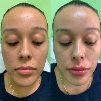 23-Before-After-Pics-Liposuction_Tummy-Tuck_Breast-Augmentation_Implant_-Botox_Lip-Fillers_El-Monte-CA-91731-ohl8085wiw0rsfc452137jsq995bp7rxejimabhdwg