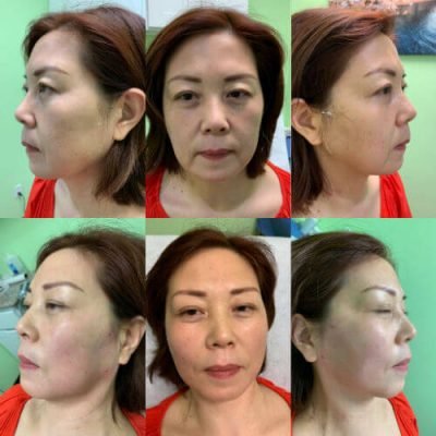27-Before-After-Pics-Liposuction_Tummy-Tuck_Breast-Augmentation_Implant_-Botox_Lip-Fillers_El-Monte-CA-91731-ohl80bx9a85x2v6nj3nlhiukmsmsk06ur24k7fbt7k