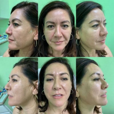 30-Before-After-Pics-Liposuction_Tummy-Tuck_Breast-Augmentation_Implant_-Botox_Lip-Fillers_El-Monte-CA-91731-ohl802ivdvt1urkb1zlbsl7yoxx4f15jdrlpenpqxs