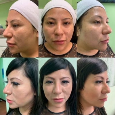 32-Before-After-Pics-Liposuction_Tummy-Tuck_Breast-Augmentation_Implant_-Botox_Lip-Fillers_El-Monte-CA-91731-ohl816xxjrcdpzxlhz2a9t0s8idwm0lzvbnl1k1ti8