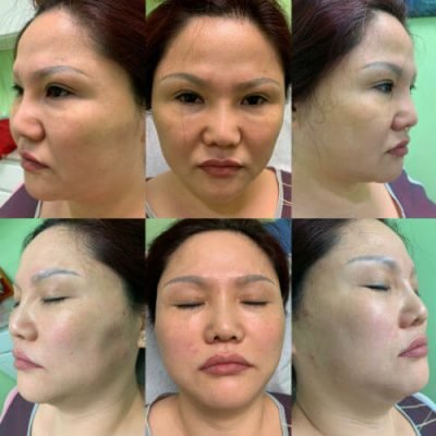 33-Before-After-Pics-Liposuction_Tummy-Tuck_Breast-Augmentation_Implant_-Botox_Lip-Fillers_El-Monte-CA-91731-ohl7x3d9qrqd37vyfp9uwc9ez0la1jc4z18cp44mn4