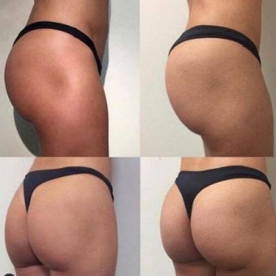 904-Liposuction_Tummy-Tuck_Breast-Augmentation_Implant_-Botox_Lip-Fillers_El-Monte-CA-91731-ohl811awer4nsc5sewmiuug0o75pbtzlujqo5wa6jk