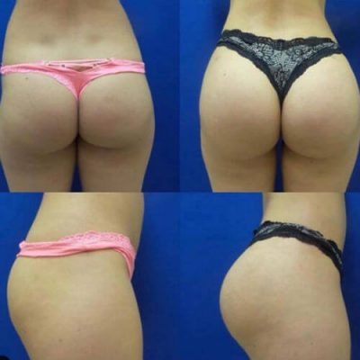 905-Liposuction_Tummy-Tuck_Breast-Augmentation_Implant_-Botox_Lip-Fillers_El-Monte-CA-91731-ohl8136ksf78fk323xfrztyxuywfr872it1n4g7e74