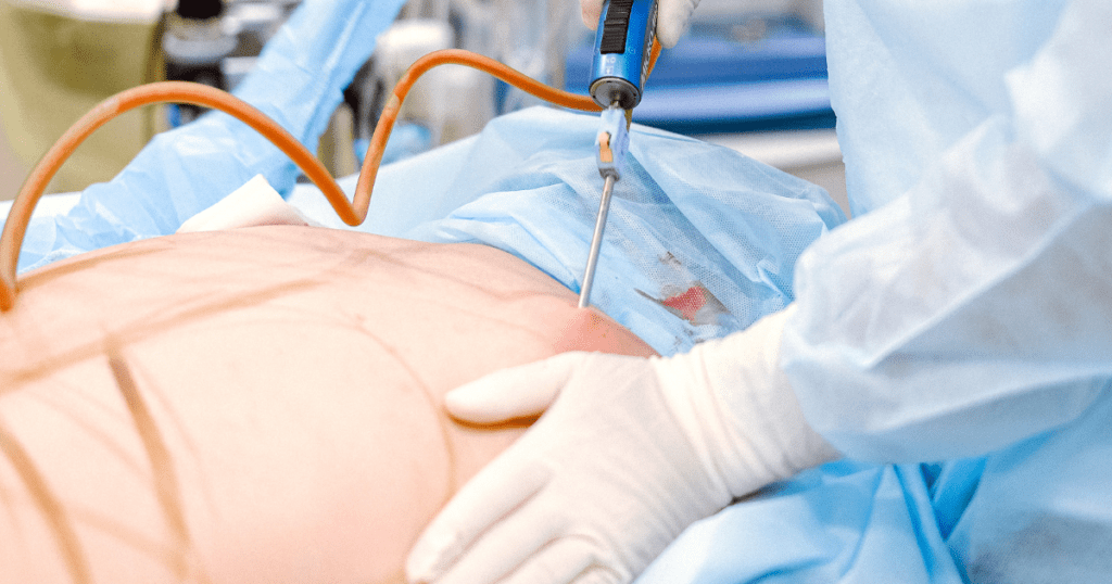 Comparing Non-Surgical and Traditional Liposuction | Anew Laser MD