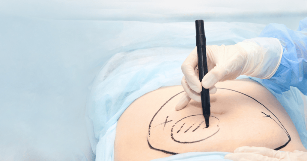 How Liposuction and Fat Transfer Can Transform Your Body | Anew Laser MD