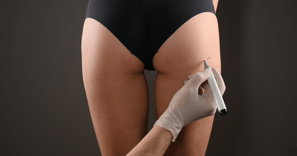 Long-Term Benefits of Sculptra Butt Lift | Anew Laser MD