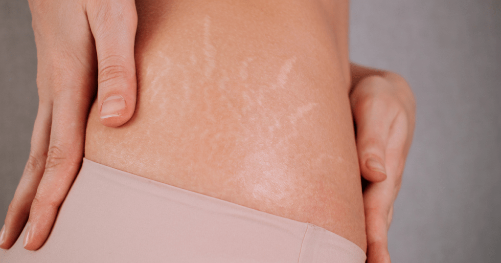 Microneedling for Body Rejuvenation and Stretch Marks | Anew Laser MD El Monte and Newport Beach