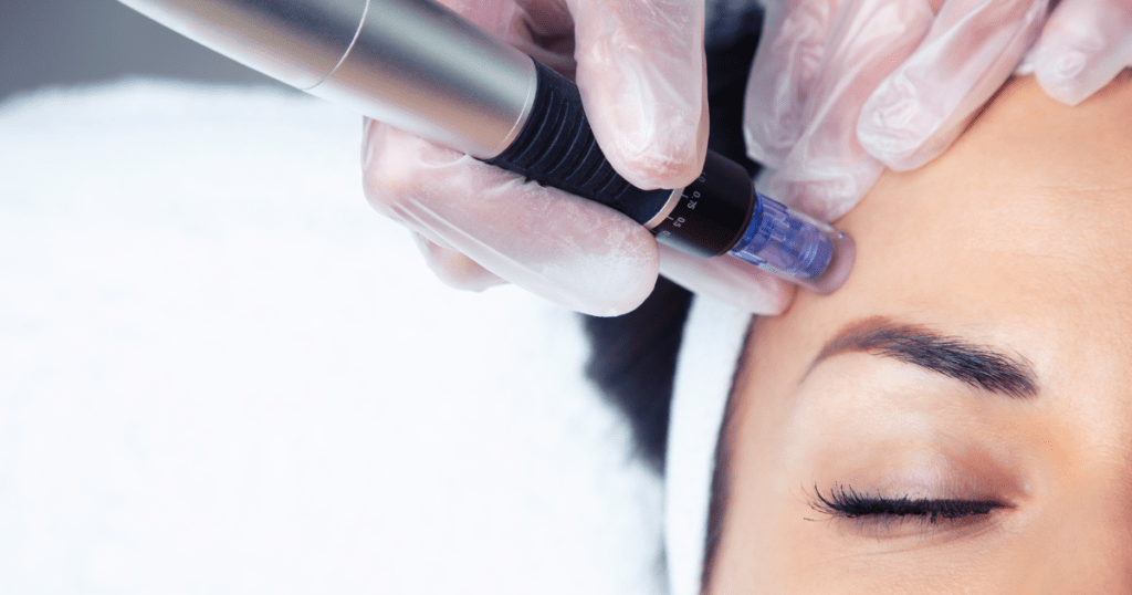 The Microneedling Process for the Body | Anew Laser MD El Monte and Newport Beach